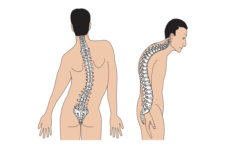 Cong vẹo cột sống