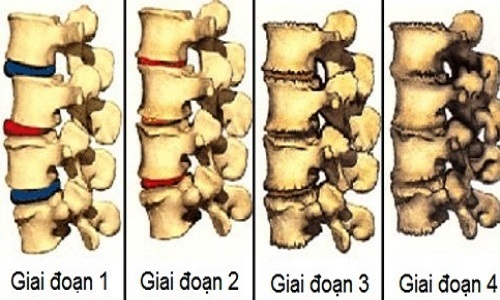 Thoái hóa cột sống thắt lưng