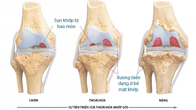 Thoái hoá khớp gối